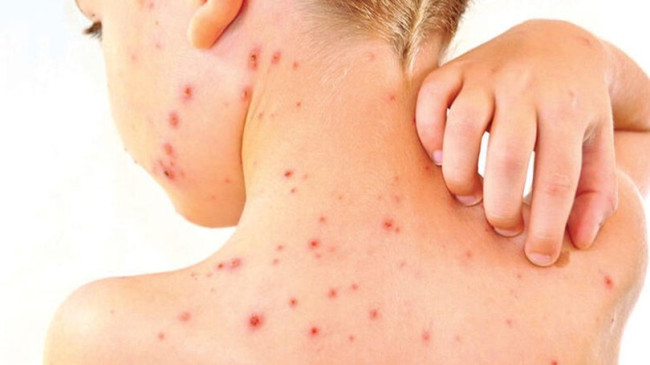 Kızamık Hastalığı Belirtileri Nelerdir? Kızamık Hastalığı Nedir?