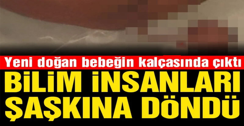 Yeni Doğan Bebeğin Kalçasında Çıktı