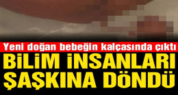 Yeni Doğan Bebeğin Kalçasında Çıktı