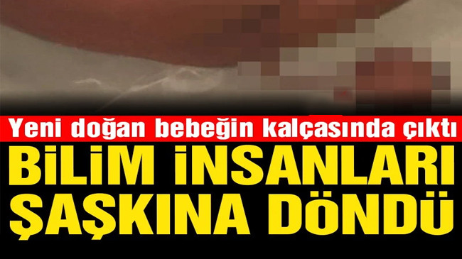 Yeni Doğan Bebeğin Kalçasında Çıktı
